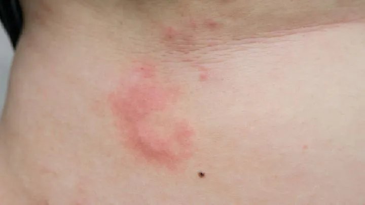 寒冷性荨麻疹你要知道这些