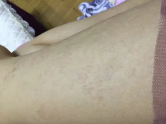 皮肤过敏和湿疹有什么区别?
