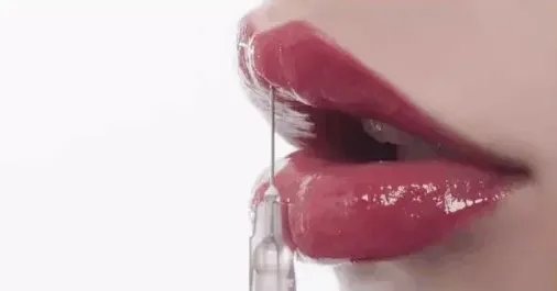玻尿酸丰唇手术的价格