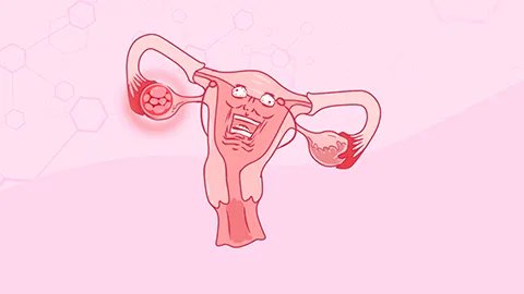 腹膜恶性间皮瘤是什么