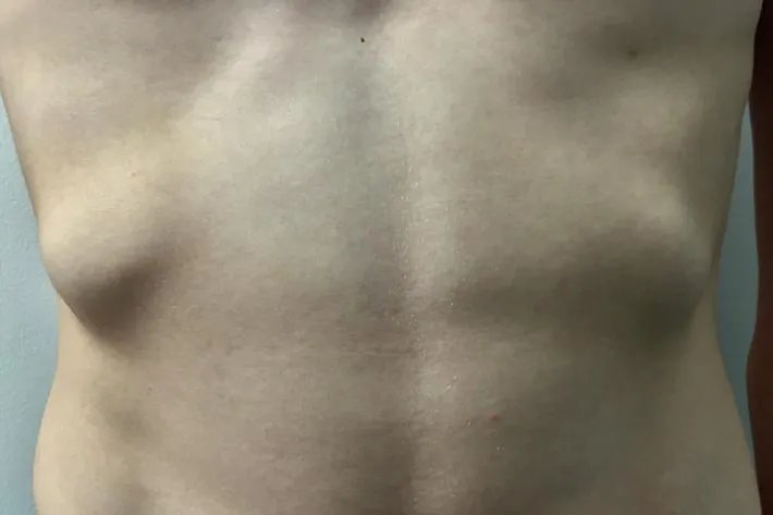 女人肋骨突出图片