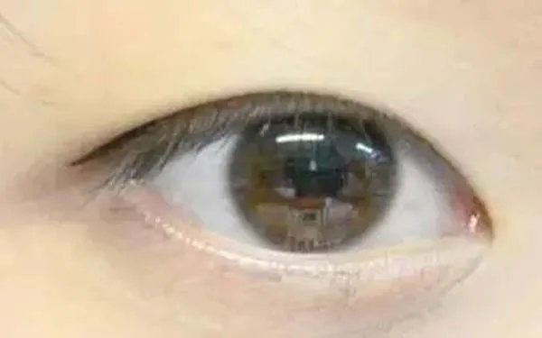 重庆埋线双眼皮哪几个整形医院口碑好