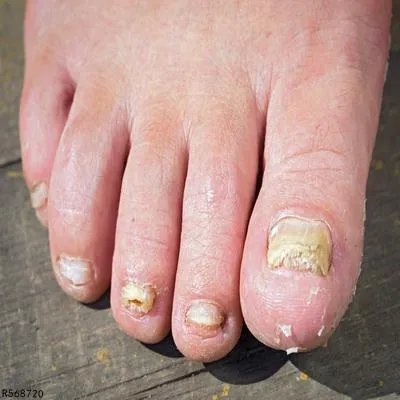 醋精可以治灰指甲吗 醋精如何治疗灰指甲