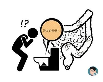 女子灌肠肠道穿孔:这种排毒“新手段”,害惨了多少中国女性?