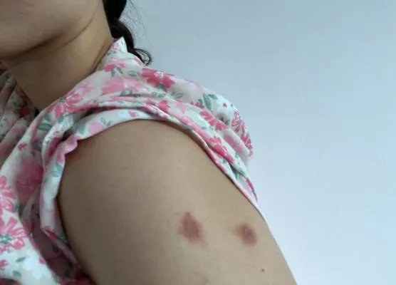 隐翅虫咬人后图片,网友实拍五花八门隐翅虫咬伤后画面