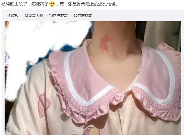 隐翅虫咬人后图片,网友实拍五花八门隐翅虫咬伤后画面