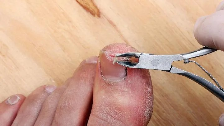 甲沟炎的症状诊断
