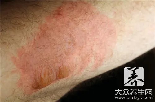鱼石脂软膏的作用是什么呢?