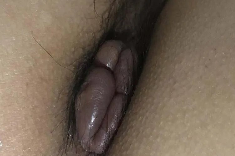外痔疮照片