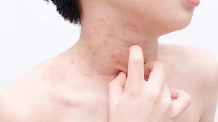 皮肌炎应该多吃什么