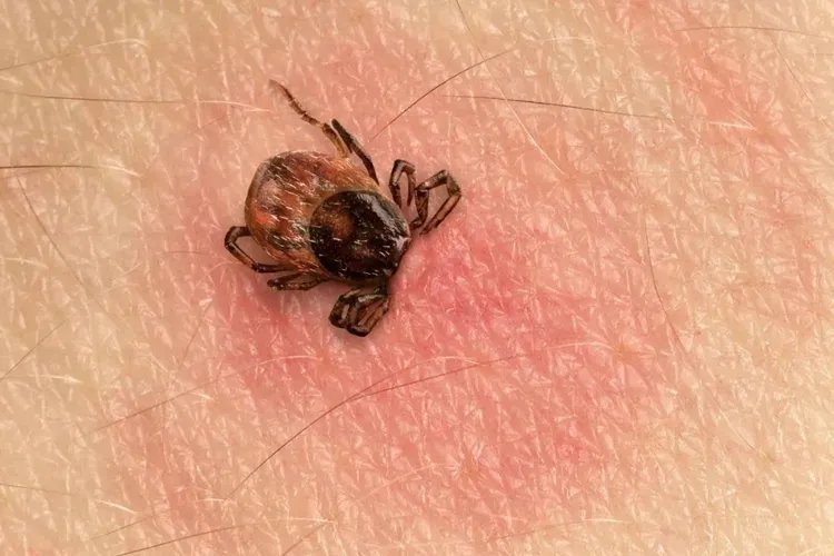 各种虫咬性皮炎过敏图片