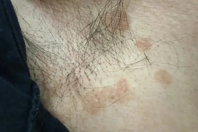 腋下汗斑图片