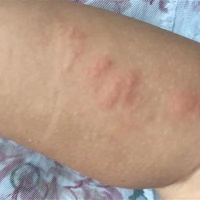 打点滴过敏怎么回事?