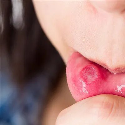 口腔溃疡是什么原因引起的?