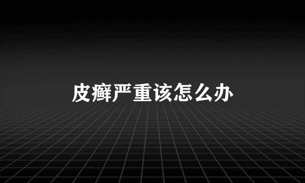 皮癣严重该怎么办