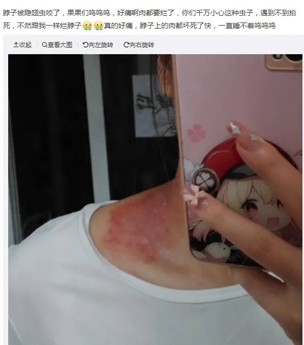 隐翅虫咬人后图片,网友实拍五花八门隐翅虫咬伤后画面