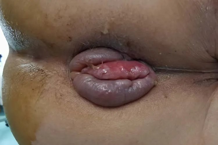 外痔疮照片