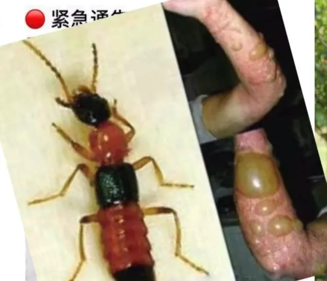 隐翅虫咬人后图片,网友实拍五花八门隐翅虫咬伤后画面
