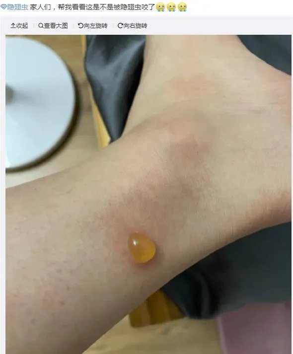 隐翅虫咬人后图片,网友实拍五花八门隐翅虫咬伤后画面