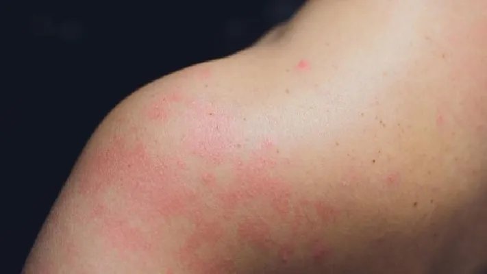 到底痒疹怎么检查出来吗
