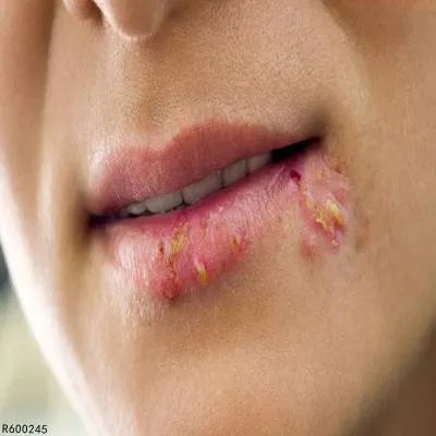 治疗唇炎的好方法介绍 四个方法治唇炎效果不错