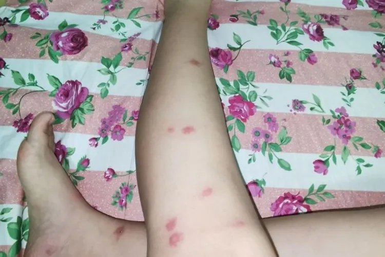 小儿丘疹图片