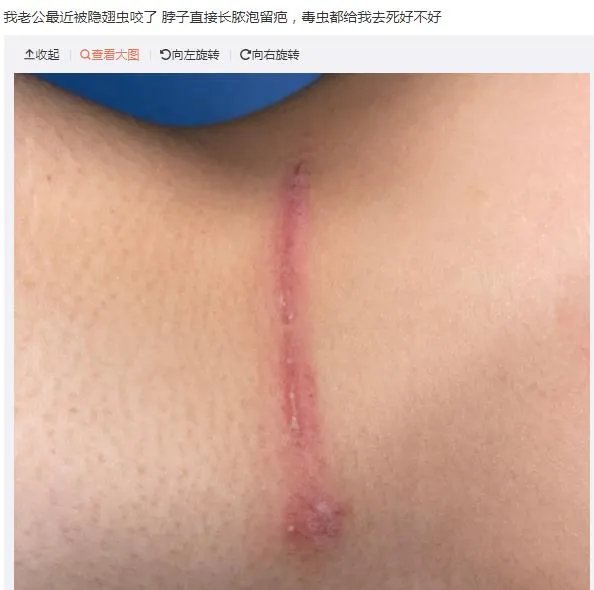 隐翅虫咬人后图片,网友实拍五花八门隐翅虫咬伤后画面