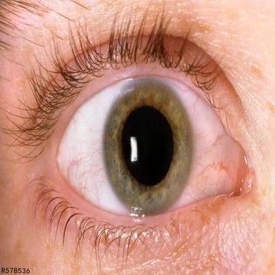 黄斑水肿治疗需要多少钱