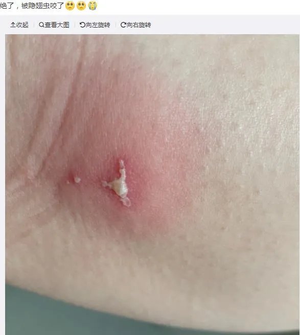 隐翅虫咬人后图片,网友实拍五花八门隐翅虫咬伤后画面