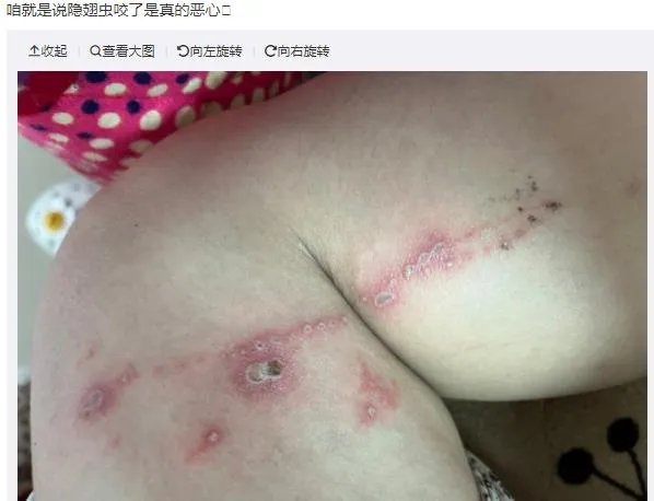 隐翅虫咬人后图片,网友实拍五花八门隐翅虫咬伤后画面
