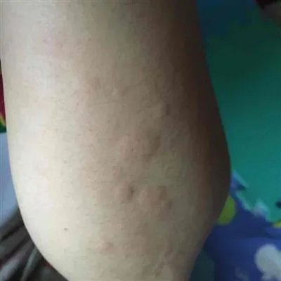 急性荨麻疹什么症状