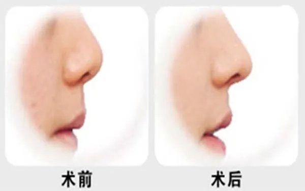 软骨隆鼻手术多少钱
