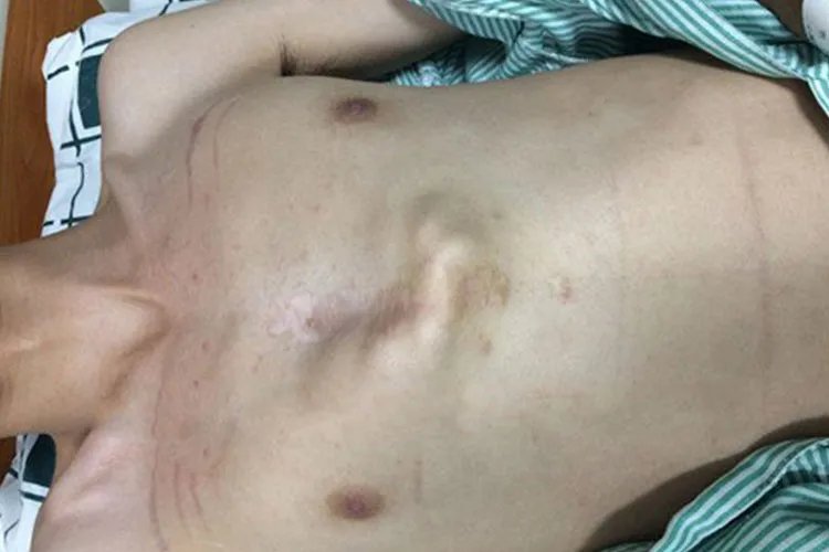 鸡胸患者图片