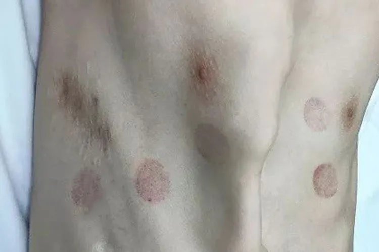 鸡胸患者图片