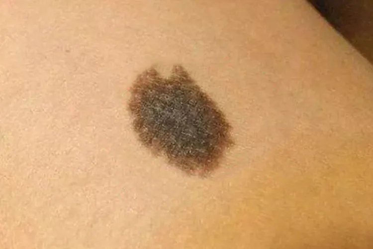 儿童黑色素瘤早期症状图片