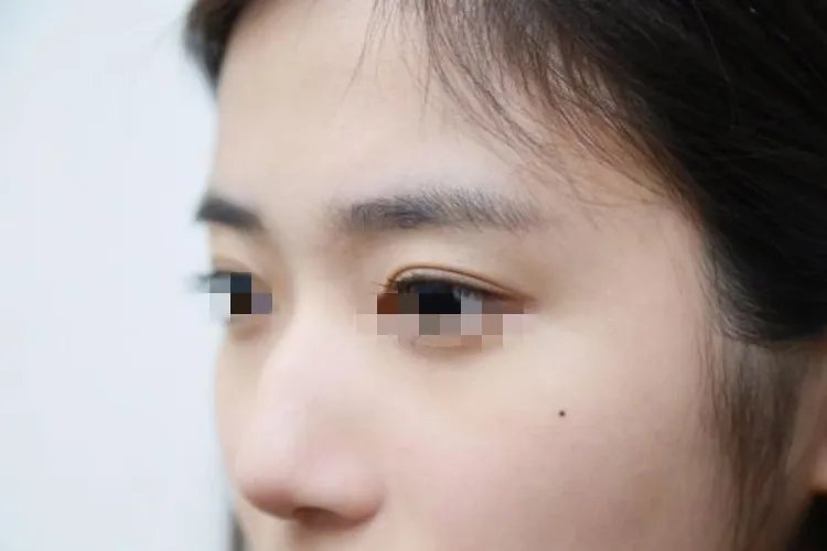 人工双眼皮和天然的区别图片