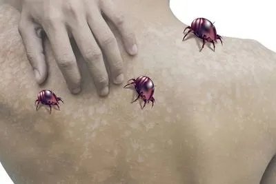 床上有螨虫咬后是什么症状