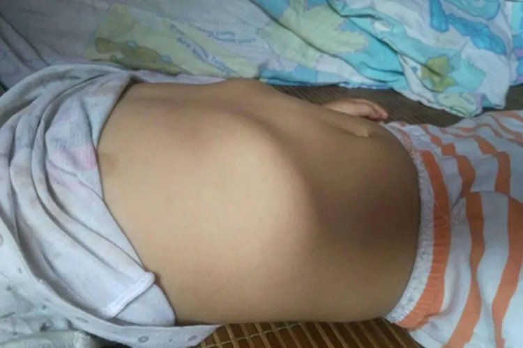 肋骨外翻躺下图片