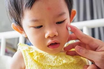 孩子被蚊子咬了肿很大是什么原因