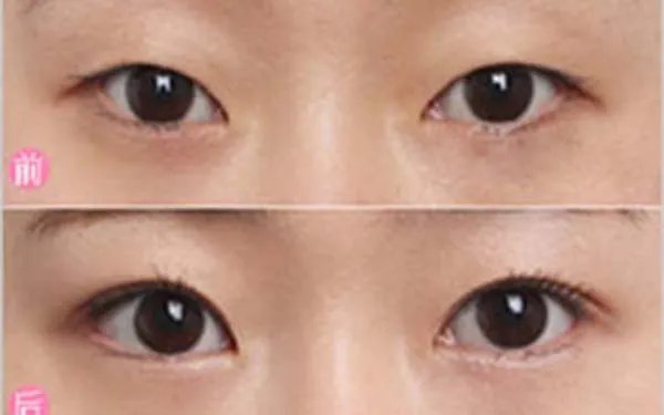 北京哪家医院做双眼皮修复好？