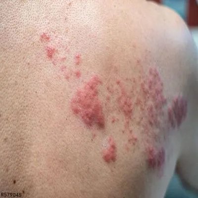 病毒性疱疹怎样治疗 病毒性疱疹常用四个方法治疗