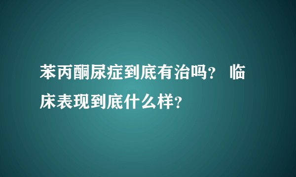 苯丙酮尿症到底有治吗？ 临床表现到底什么样？